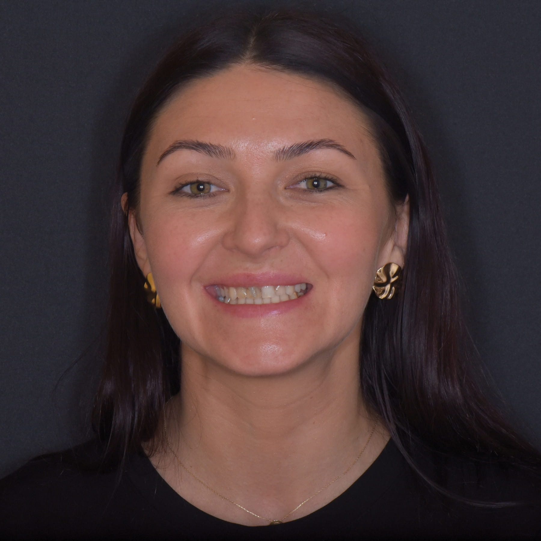 Înainte de fațete și coroane Emax — Betadent Clinic Cluj