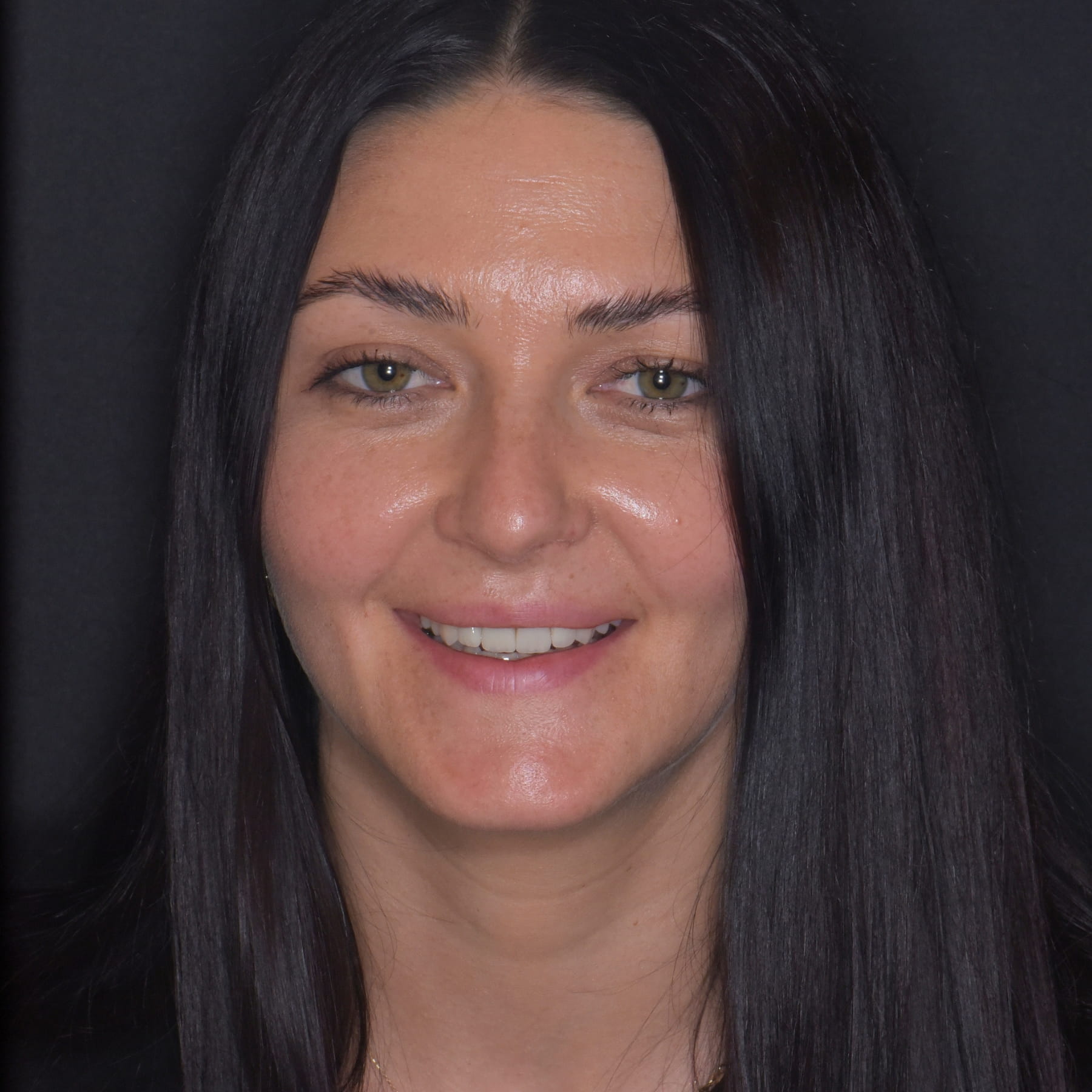 După fațete și coroane Emax — Betadent Clinic Cluj