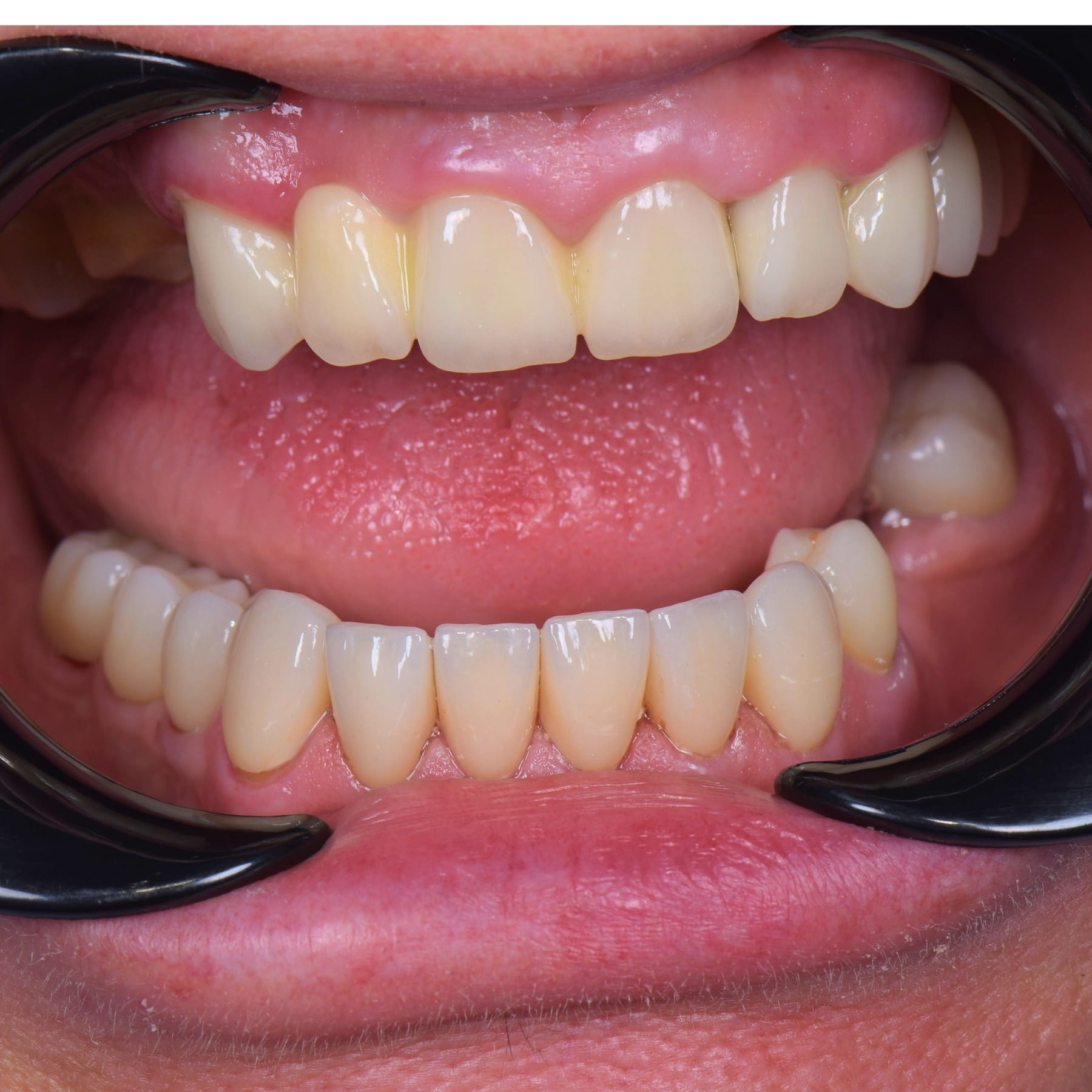 Lucrare finală din zirconiu — Betadent Clinic Cluj