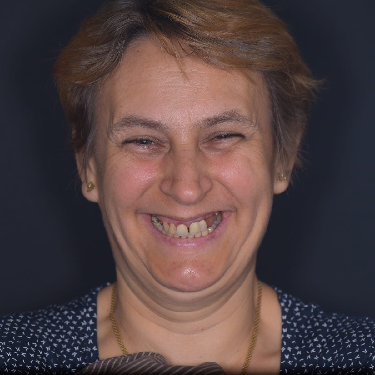 Caz Dna. K.G. — implanturi cu ghid chirurgical, Betadent Clinic Cluj (imaginea 1 din 4)