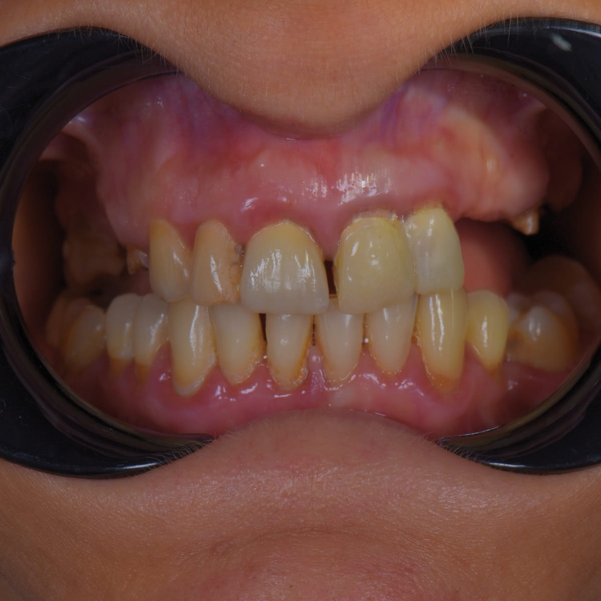 Caz Dna. K.G. — implanturi cu ghid chirurgical, Betadent Clinic Cluj (imaginea 2 din 4)