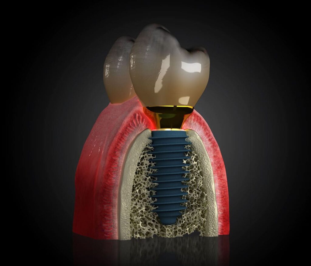 Cât costă un implant dentar în Cluj-Napoca la Clinica Betadent?