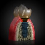 Cât costă un implant dentar în Cluj-Napoca la Clinica Betadent?