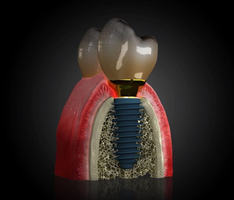 Cât costă un implant dentar în Cluj-Napoca la Clinica Betadent?