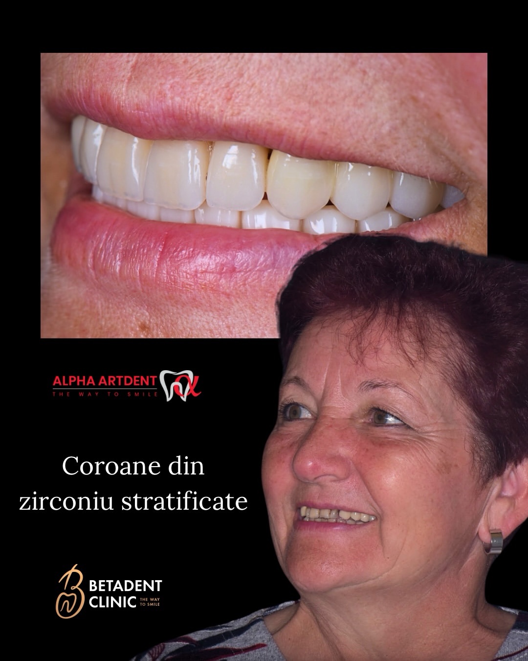 Coroane din zirconiu stratificat, rezultat final — Betadent Clinic, Cluj-Napoca