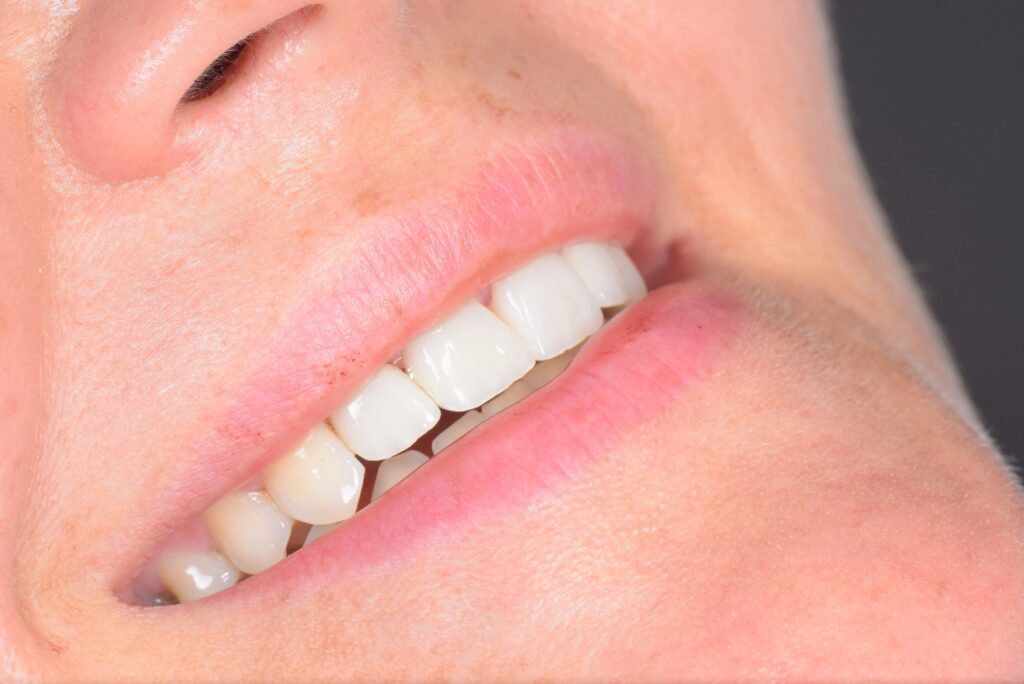 Fatete dentare ieftine Cluj: ce ascunde pretul mic