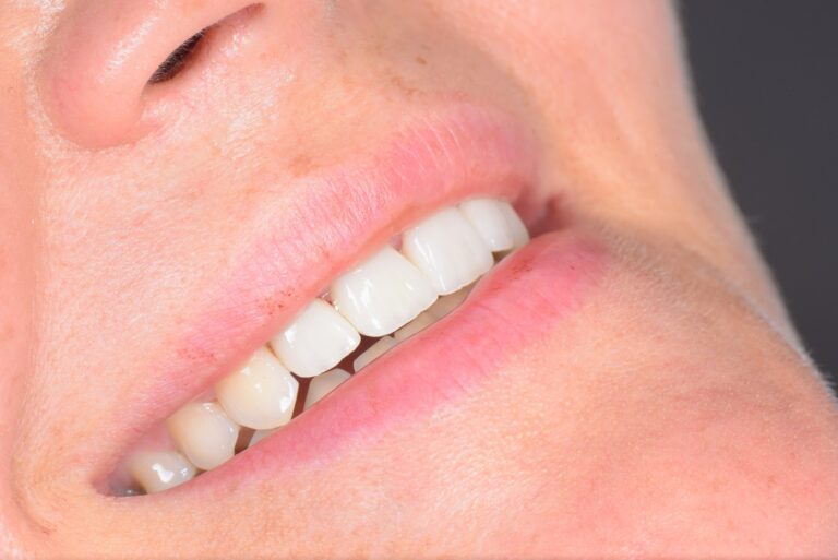 Fatete dentare ieftine Cluj: ce ascunde pretul mic
