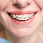 Cât Costă un Aparat Dentar în Cluj | Prețuri 2026 Betadent