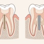 Scos pivot dentar: cum se face fără să se fractureze rădăcina